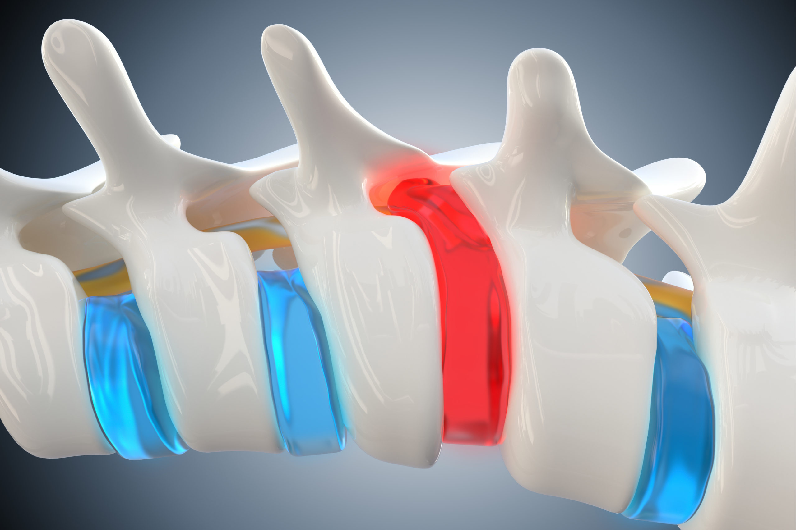 Compressed Disc In Neck Severe cervical disc herniation caused