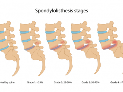 Spondylolisthesis stages
