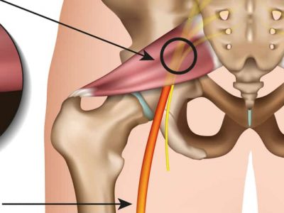 piriformis syndrome