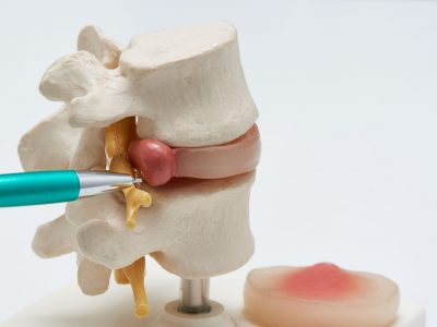 A,Pen,Pointing,At,Herniated,Artificial,Human,Lumbar,Disc,Model