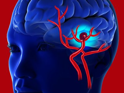 Cerebral,Aneurysm,3d,Rendering.,Brain,Aneurysm,Closeup.