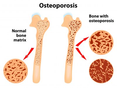 Osteoporosis,-,Is,A,Disease,Of,Bones,That,Leads,To