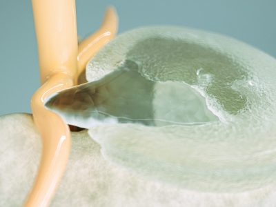 Spinal,Disc,Herniation,As,Close-up,Detailed,3d,Rendering