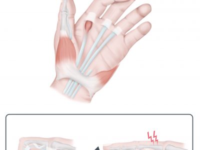 Medical,Illustration,To,Explain,Trigger,Finger