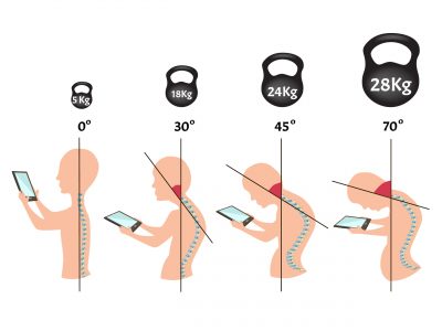 Improper,Posture,Symptoms.,Stage,Text,Neck,Syndrome.,Spinal,Curvature,,Kyphosis,