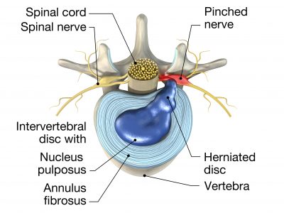 3d,Illustration,Showing,Painful,Herniated,Disc,Or,Slipped,Disc