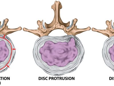 Types,And,Stages,Of,Lumbar,Disc,Herniation,,Herniated,Disc,,Nuclear
