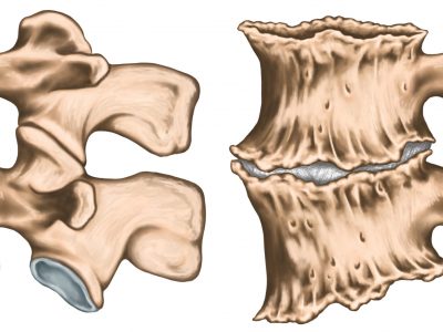 Spondylophytes,Involving,A,Spinal,Motion,Segment,,Advanced,Uncovertebral,Arthrosis,,Third